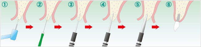 OAM Implant System®